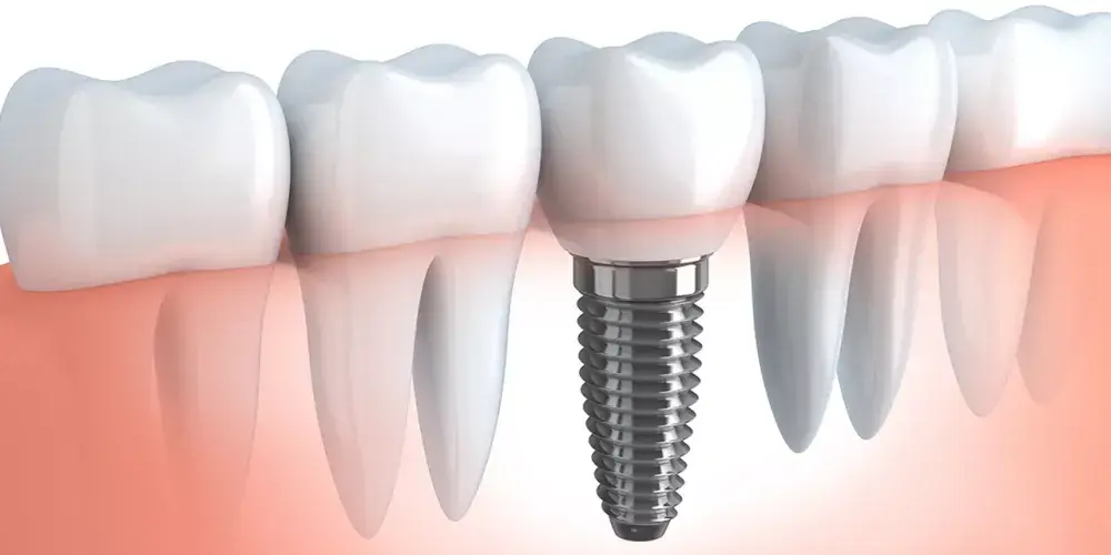 Dental Implants Hungary Helvetic Clinics Why Patients Choose Helvetic Clinics Dental Implants Hungary Helvetic Clinics